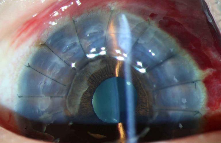 全球首例iPS细胞培养角膜移植成功