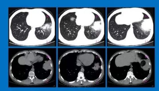 助力全球抗疫 我科学家分享肺部超声影像学诊疗经验
